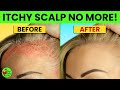DIY Scalp Psoriasis Treatment 10 Simple Home Recipes