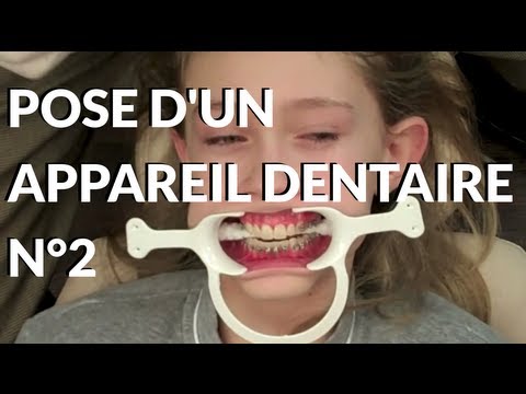 comment reparer appareil dentaire casse