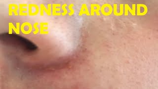 how to get rid of redness around nose