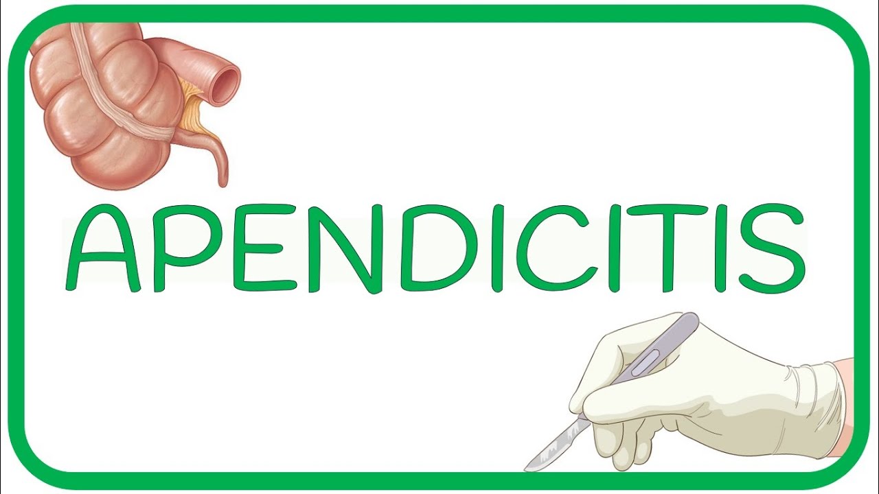APENDICITIS - causas, fisiopatología, síntomas, diagnóstico y tratamientos  |  CIRUGÍA