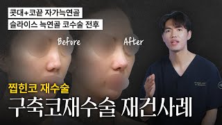 (찝힌코재수술) 구축코재수술 재건사례 [늑떼선생김현주의 수술사례 및 케이스리뷰]
