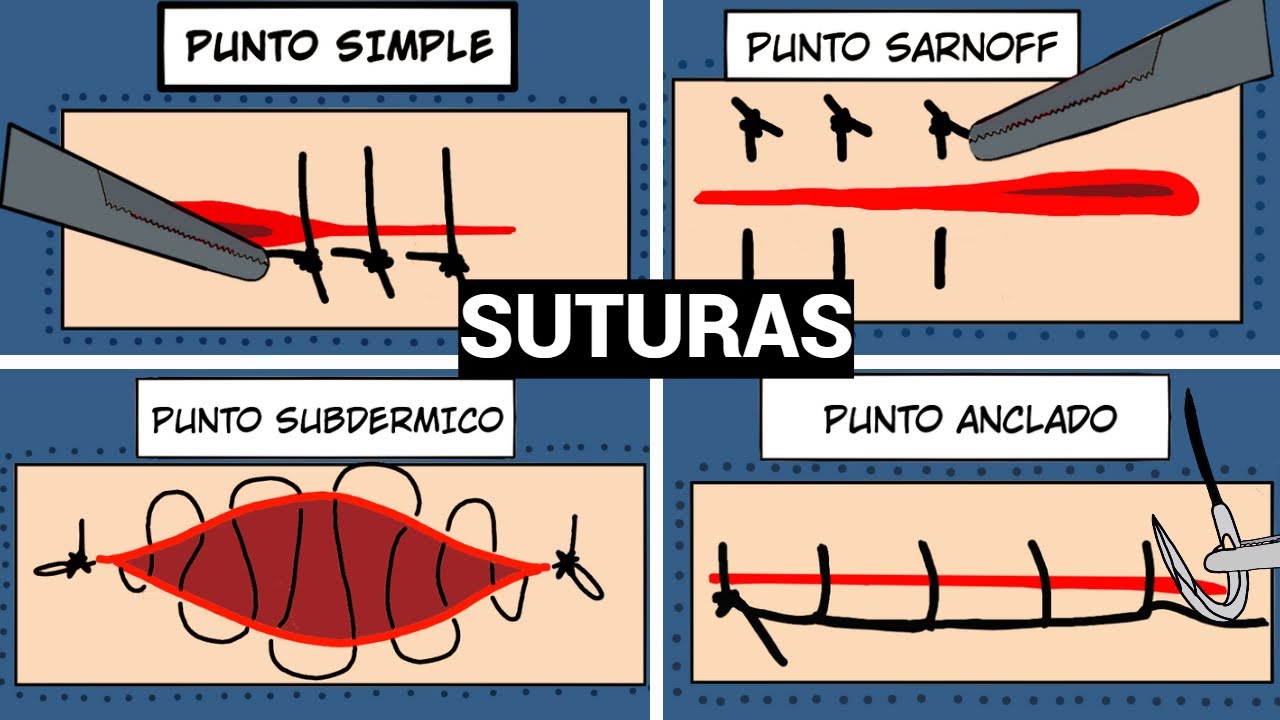 SURGICAL SUTURES | SIMPLE, SARNOFF, SUBDERMAL AND ANCHORED #suture