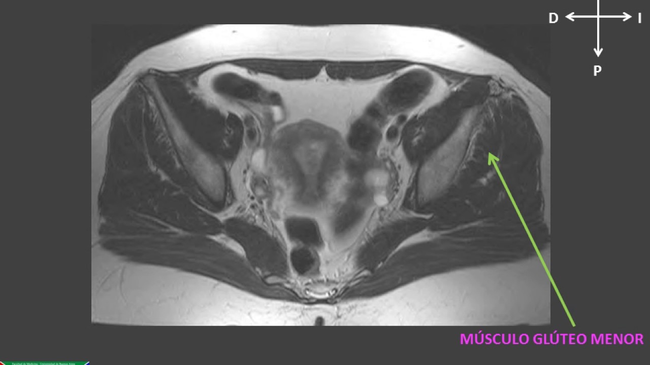 Watch PELVIS FEMENINA RESONANCIA MAGNÉTICA Now PELVIS FEMENINA RESONANCIA MAGNÉTICA