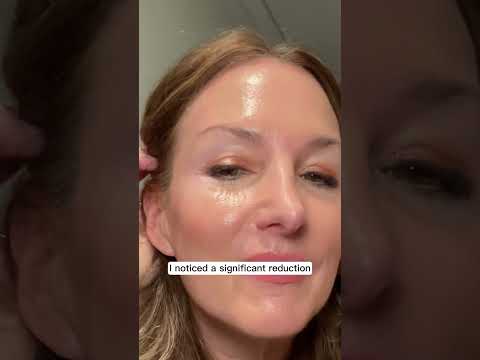 Unlock your skin's natural radiance with Glamory. #MicroInfusion#GlowingSkin