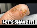 WHAT'S UNDERNEATH THIS CALLUS?
