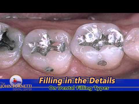 Smilecast: Filling in the Details on Fillings