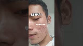 Download lagu Udah gatau lagi deh mau bilang apalagi soal laser erbium. Sebagus itu😭 nadifaclinic #acnefighter mp3 Download lagu Udah gatau lagi deh mau bilang apalagi soal laser erbium. Sebagus itu😭 nadifaclinic #acnefighter mp3