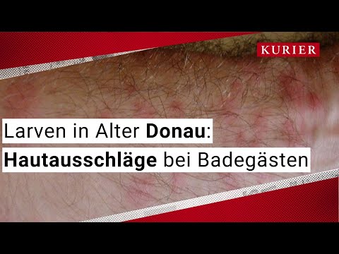 Juckreiz und Ausschläge: Zerkarien in Alter und Neuer Donau