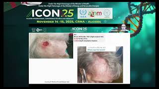 Rhenium188 in Skin Cancer Therapy Pr CASTELLUCI