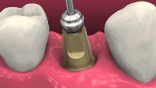 Restoring dental implants video BioHorizons