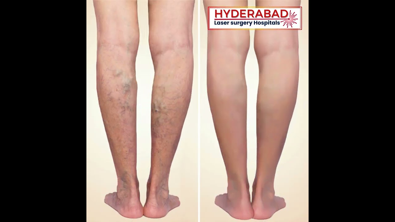 Varicose Veins Laser Treatment Video - Hyderabad Laser Surgery Hospital