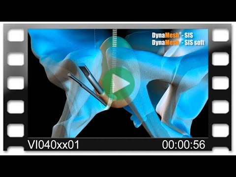 DynaMesh®-SIS - Animation: Surgical Treatment of Stress Urinary Incontinence - SUI - TVT 8/4
