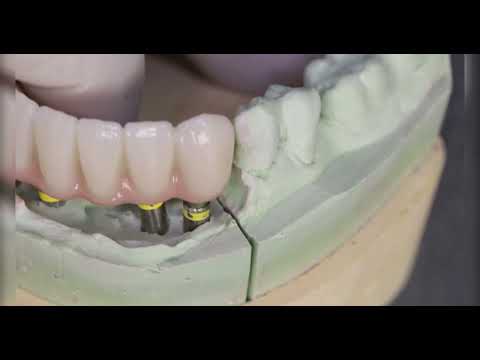 Zolid gen-x Multilayer High Translucent Zircon A1 Shade. Staining & Glazeing