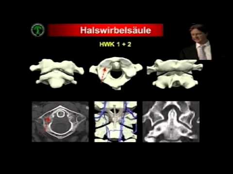 Osteochondrose der lumbalen Vorsprung Übungen Beide stechend traumel mit Osteochondrose
