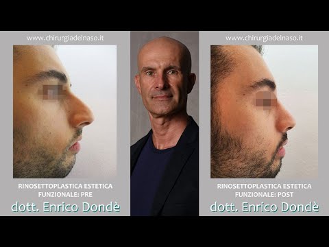 Rinosettoplastica naso "a clessidra" | Dr. Enrico Dondè