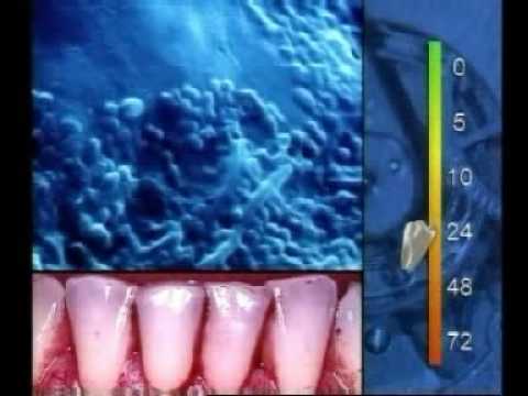 Die professionelle Zahnreinigung. Video