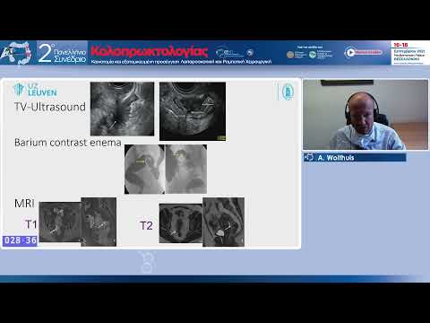 Wolthuis Α. - Laparoscopic management of bowel endometriosis