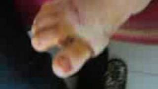 alluce valgo risultato nuova tecnica. sconsiglio vivamente