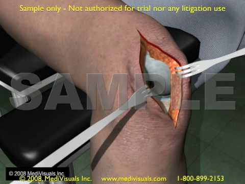 Femur Intramedullary (IM) Rodding