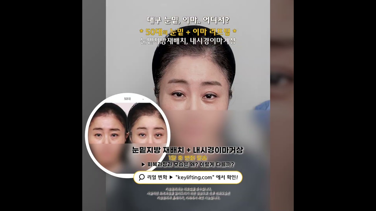 50대의 눈밑지방재배치 + 이마거상
