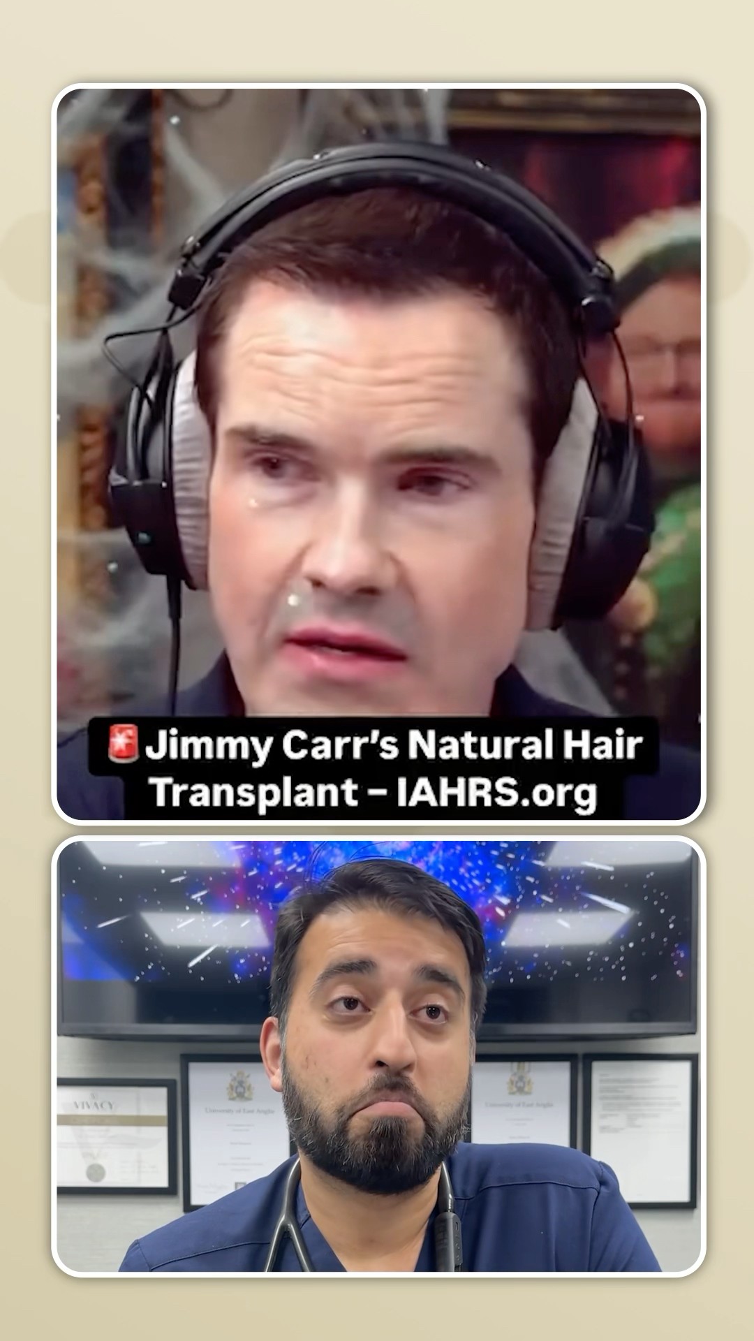 Celebrity Hair Transplant Hit or Miss