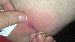 Popping BOIL Betwen Legs Part 1