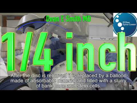 Least Invasive Anterior Lumbar Fusion