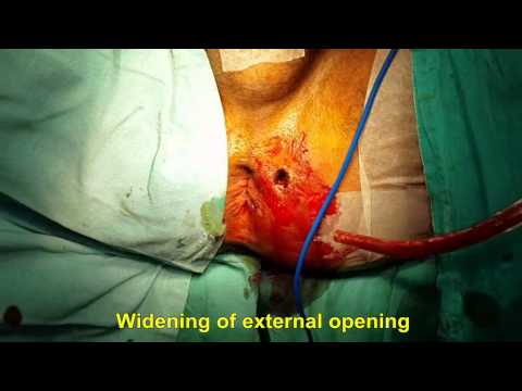 Anal Fistula cured by PERFACT OPERATION :Best painless treatment in world by expert surgeon in India