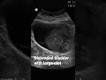 Bladder With Large Clot