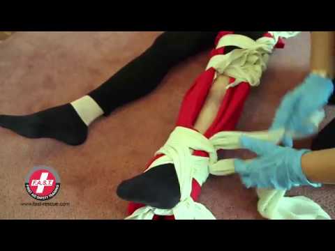 How to treat a Leg Fracture