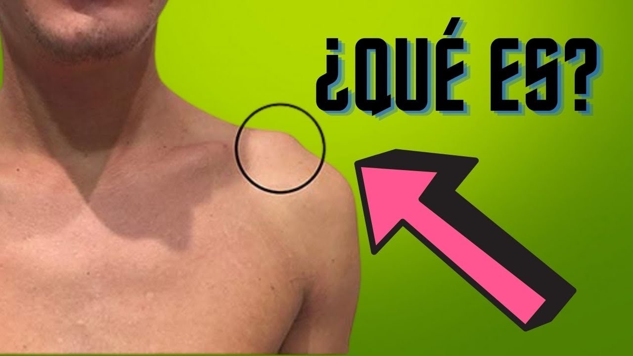 Qué es esta bolita en el hombro
