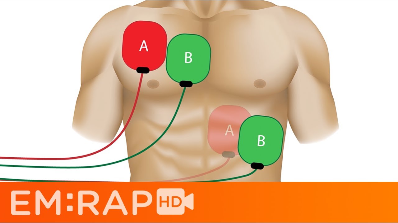 Double Sequential Defibrillation