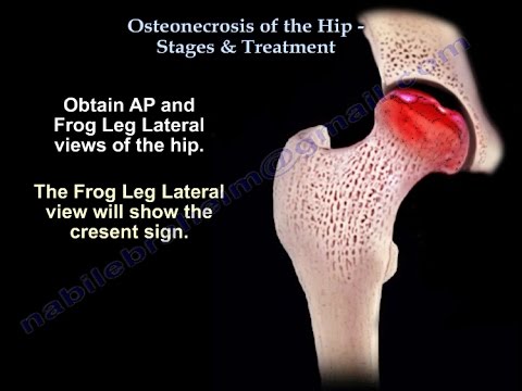 Osteonecrosis Of The Hip ,Stages and Treatment- Everything You Need To Know - Dr. Nabil Ebraheim