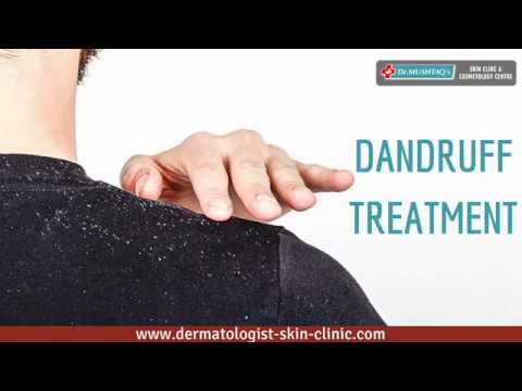 Dandruff treatment, for for treating dandruff