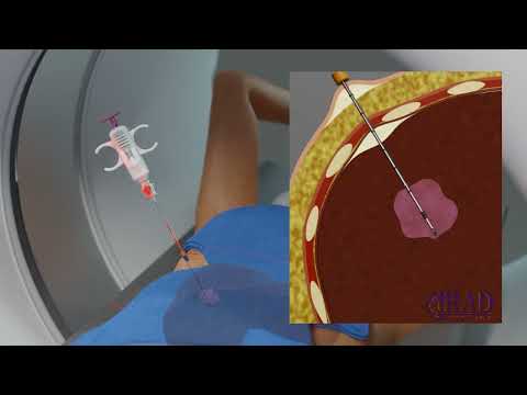 Biopsy of Liver Lesion (CT guided Biopsy of Liver Tumor )