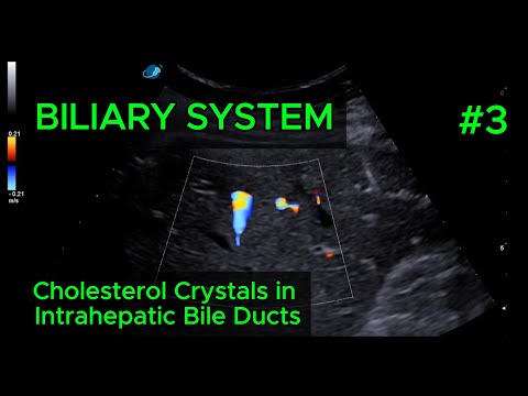 Cholesterol Crystals in Intrahepatic Bile Ducts video preview