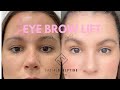 Before And After Eyebrow Lift