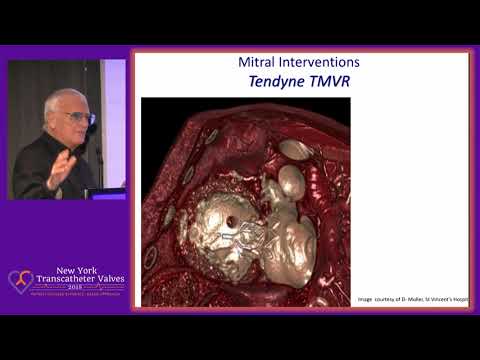 Future of TMVR: The Next Generation of Quick TMVR Beyond the MitraClip - Dr. Eberhard Grube