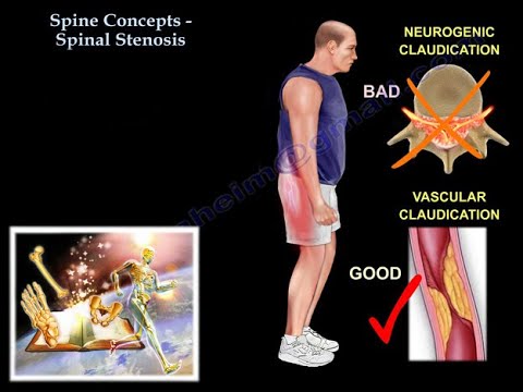 Spinal Stenosis - Everything You Need To Know - Dr. Nabil Ebraheim