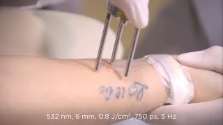 Plateaued Tattoo Treatment Video