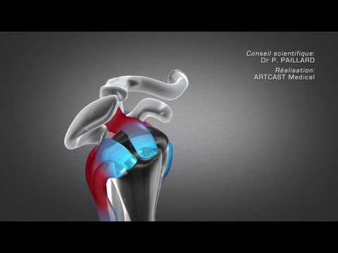 Fitness Osteochondrose Pillen für schmerzende Gelenke der Hände