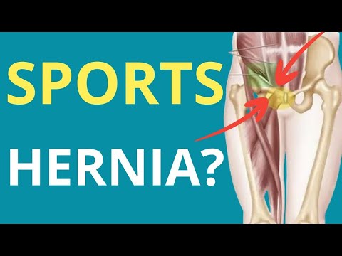 Sports Hernia vs Real Hernia: 3 Key Tests Explained