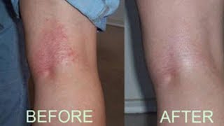 how to get rid of skin rash