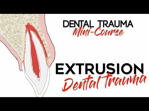 Dental Trauma Mini-Course - Part 10 - Dental Trauma Guide - Dental Extrusion Injury