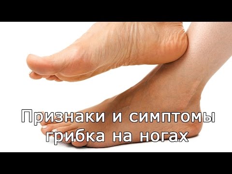 Дрожжевой грибок стопы чем лечить - О грибке ногтей Дрожжевой грибок стопы чем лечить - О грибке ногтей