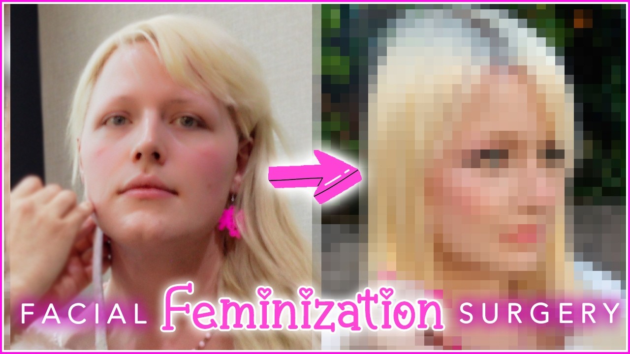 Face Reveal - I Got Facial Feminization Surgery!