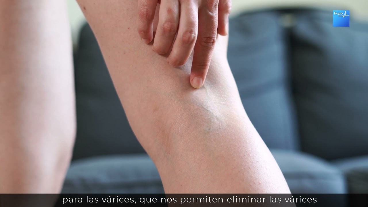 ¿Cómo es la cirugía de várices 🤔