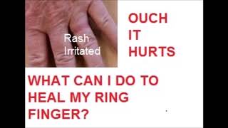 Rash? Irritated Skin? Ring Hurts? Skin Peeling Under Your Ring? Wedding Band Hurts? How to fix it