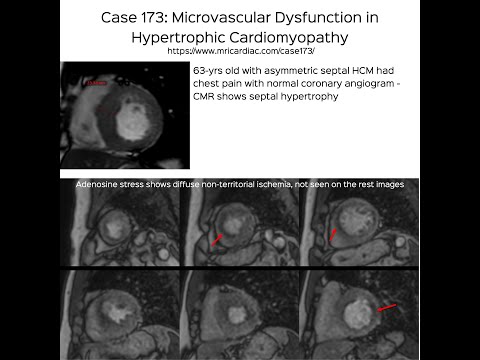 Case 173: Microvascular Dysfunction in Hypertrophic Cardiomyopathy