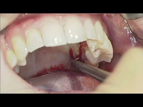 Treatment Of Mandibular Gingival Recession With A Tunnel 